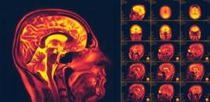 Beyinde Nöroplastisite Nedir?