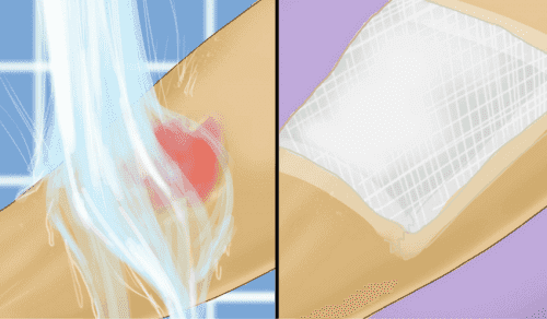 Yanıklarına soğuk su uygulayan biri.