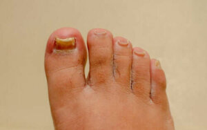 Tırnak Mantarı İçin Doğal Tedaviler İşe Yarar Mı?