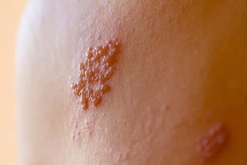 Epstein-Barr virus