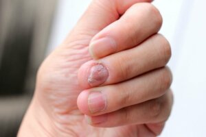 Hallopeau Sendromu Nedir?