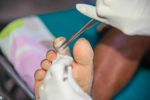 Kangren Türleri: Nedir ve Neden Gerçekleşir