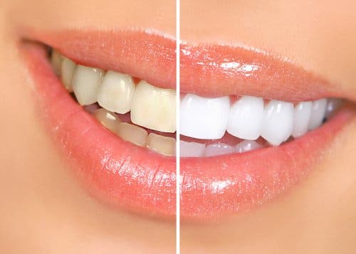 Diş beyazlatma işleminin sonuçlarını gösteren bir fotoğraf.