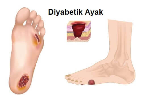 Diyabetik ayak, özel bakım gerektirir