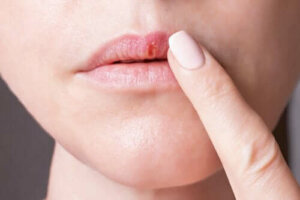 Herpes Simpleks Virüsleri ve Özellikleri