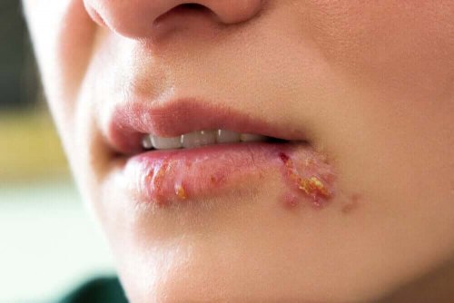 herpes simpleks tipleri