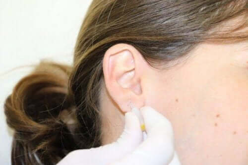 Kulak akupunktur tedavisi gören bir kişi.