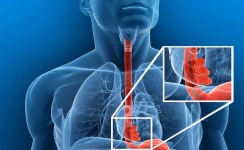 Özofagus bloklanmasının bir illüstrasyonu.