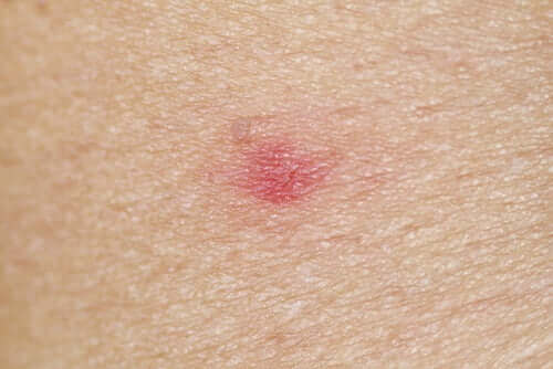 çocuklarda en yaygın alerjiler-kızarıklık