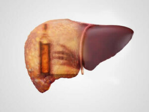 Alkolik Hepatit: Semptomları, Nedenleri ve Tedavileri