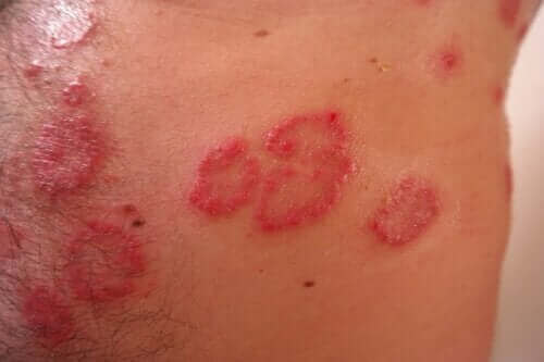 Dünya Lupus Günü: Kelebek Hastalığı