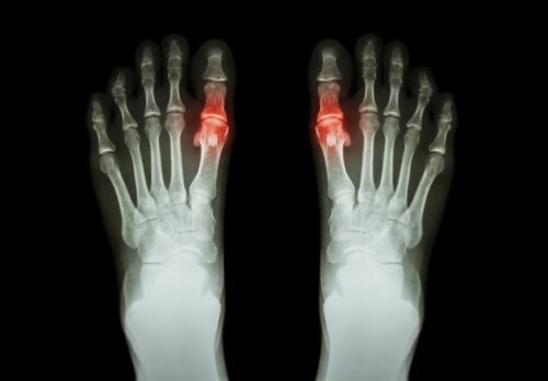 Artrit bulunduğuna işaret eden bir röntgen.