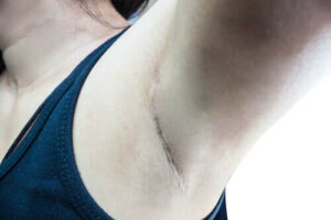 Öncü Lenf Düğümü Nedir?