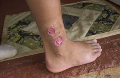 Ayak bileğinde lezyonlar