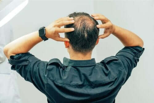 alopesi adam kafa derisi