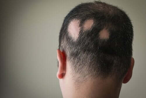 alopesi areata