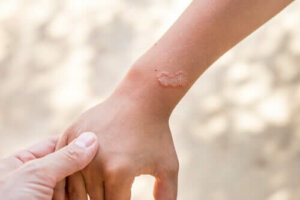 Ektoparazitler Nelerdir? Akarlar ve Pireler Hakkında Her Şey