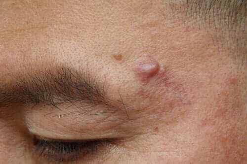 Epidermoid Kistler: Nedenleri ve Olası Tedavileri