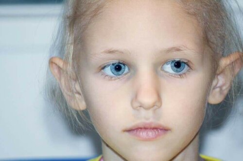 retinoblastom hastası bir çocuk