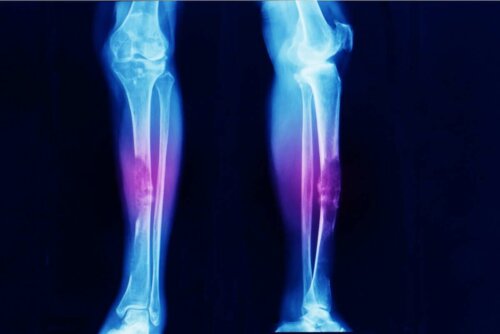 röntgen bacaklar 