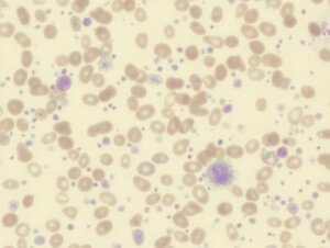 Trombositoz: Semptomlar, Nedenleri ve Tedavisi