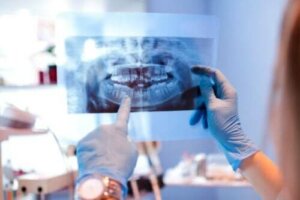 Temporomandibular Eklem Çıkığı Nedenleri