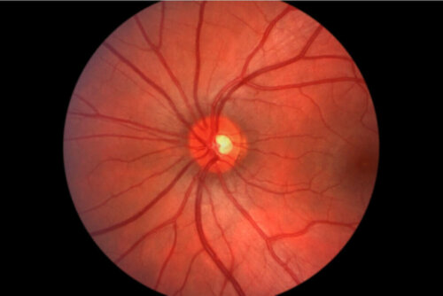 fundus göz