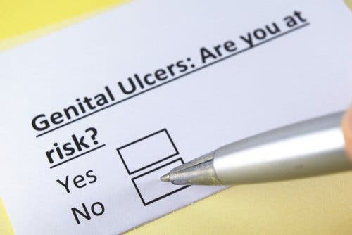 Genital ülserler hakkındaki bir soruya cevap veren bir kişi.