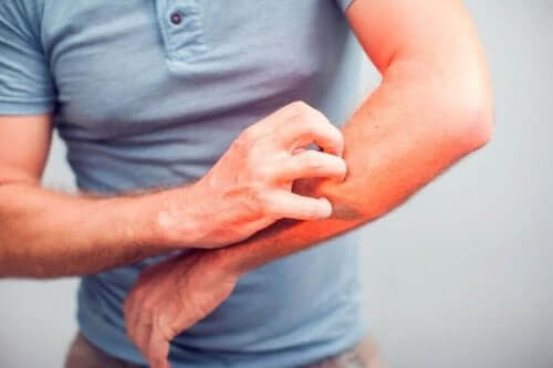 Kaşıntıyı Rahatlatmak İçin 5 Doğal Tedavi