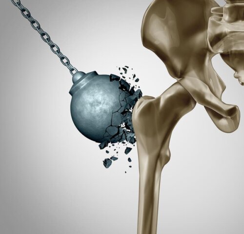 Menopozdan Sonra Osteoporozun Hasarını Azaltmak
