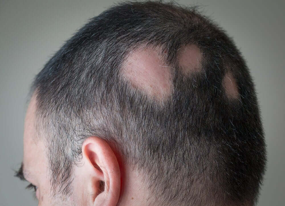 Alopesi yaşayan erkek