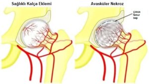Femur Başı Avasküler Nekrozu