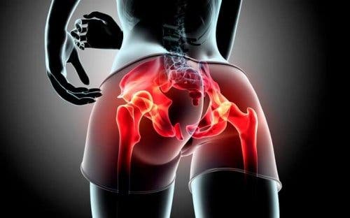 Gluteal tendinopati durumunu anatomik olarak gösteren dijital bir çizim.