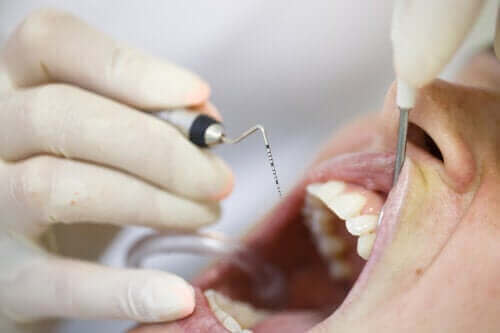 Piyore: Problemli Bir Diş Eti Hastalığı