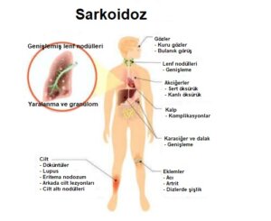 Sarkoidoz Nedir? Semptomları ve Tedavisi