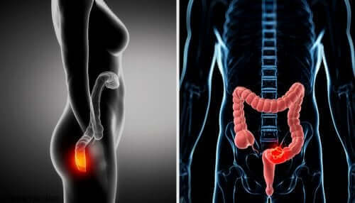 Anoskopi prosedürü için hasarlı yerlerin gösterimi