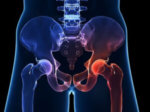 Kalça Osteoartriti: Özellikleri ve Semptomları