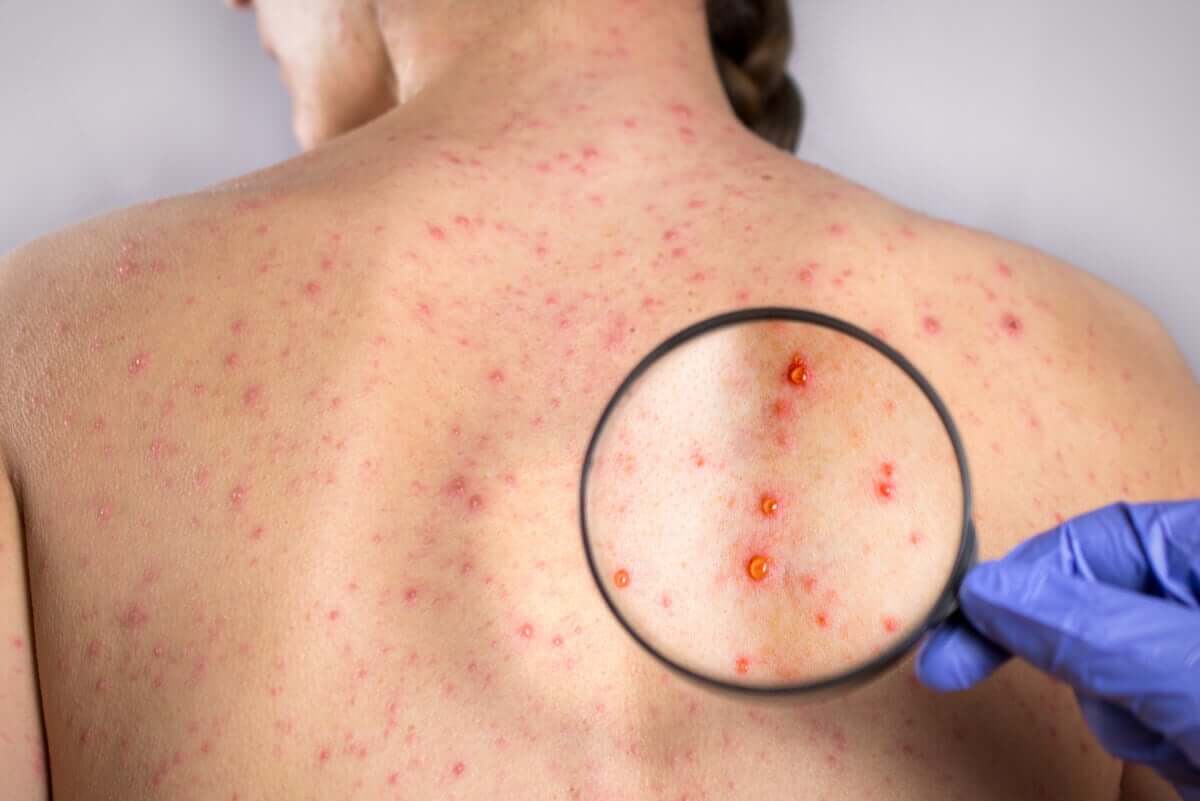 Kızamıkçık enfeksiyonu