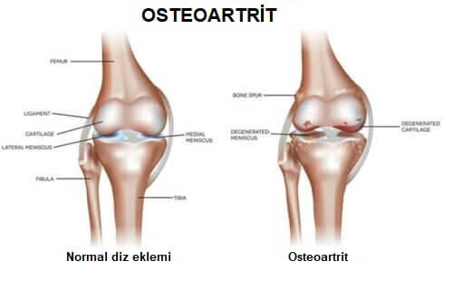 osteoartrit karşılaştırma