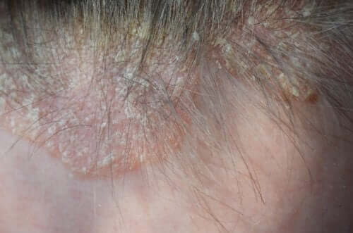 Saç Derisinde Sedef Hastalığı: Semptomları ve Tedavisi