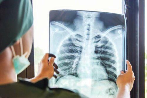 Bir hastanın akciğer röntgenini inceleyen bir doktor.