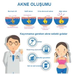 Akne Konglobata: Nedenleri ve Semptomları