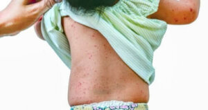 Roseola: Komplikasyonları ve Önlenmesi