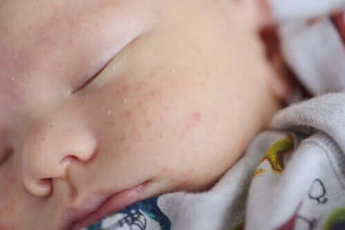 Bebeklerde Konak ve Bebek Aknesi Nasıl İyileştirilir?