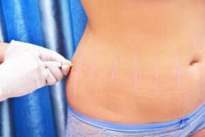 Lipoterapi Nedir ve Ne İçin Kullanılır?