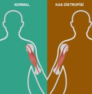 Nöromüsküler Bozukluklar: İşaretçileri ve Semptomları