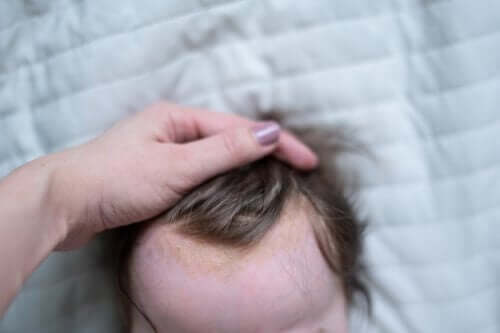 Saç derisinde cilt döküntüsü olan bir bebek.