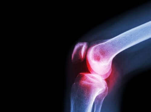 Septik Artrit: Nedenleri, Semptomları ve Tedavisi