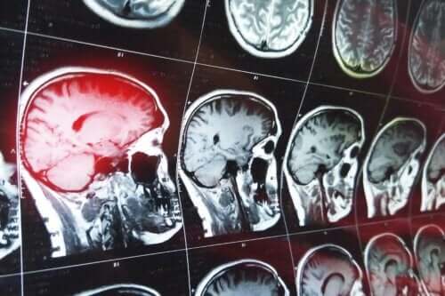 Bir dizi beyin tomografi görüntüleri
