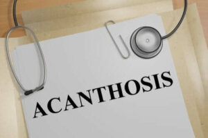 Deri Sertleşmesinin (Acanthosis Nigricans) Nedenleri